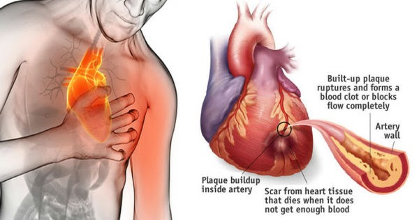 How to Prevent a Heart Attack in Just 60 Seconds Using Cayenne Pepper