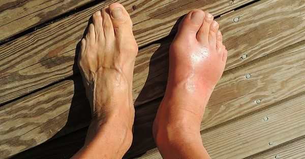 Say Goodbye to Gout Pain with Natural Juice