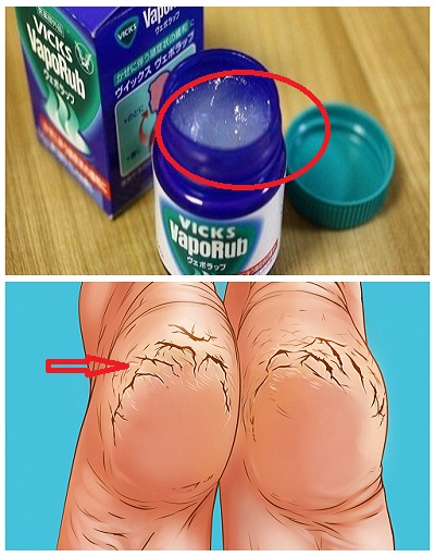She rubbed her feet with Vicks rub every night. The result will impress you!