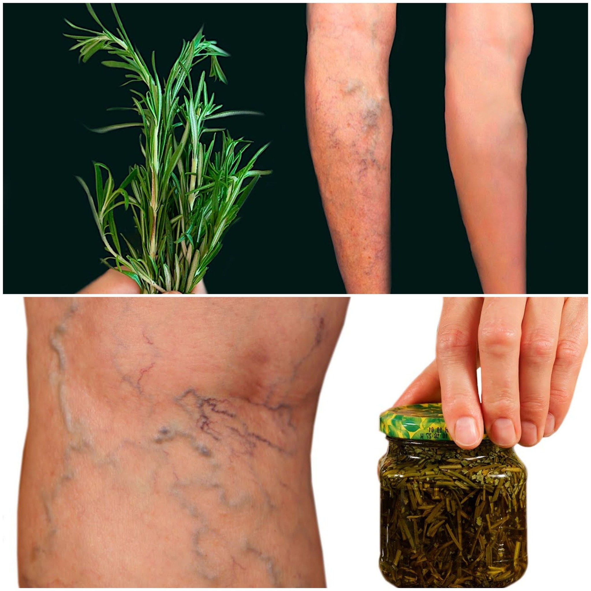 Rosemary A Natural Solution for Varicose Veins