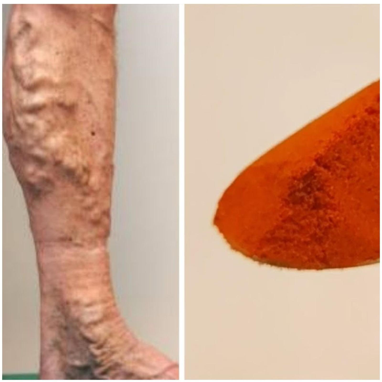 Veins and Poor Circulation with Cayenne Pepper