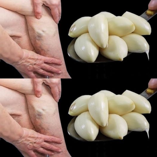 Moms Natural Remedy with Garlic