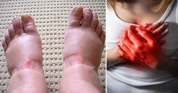 Warning Signs of Swollen Feet